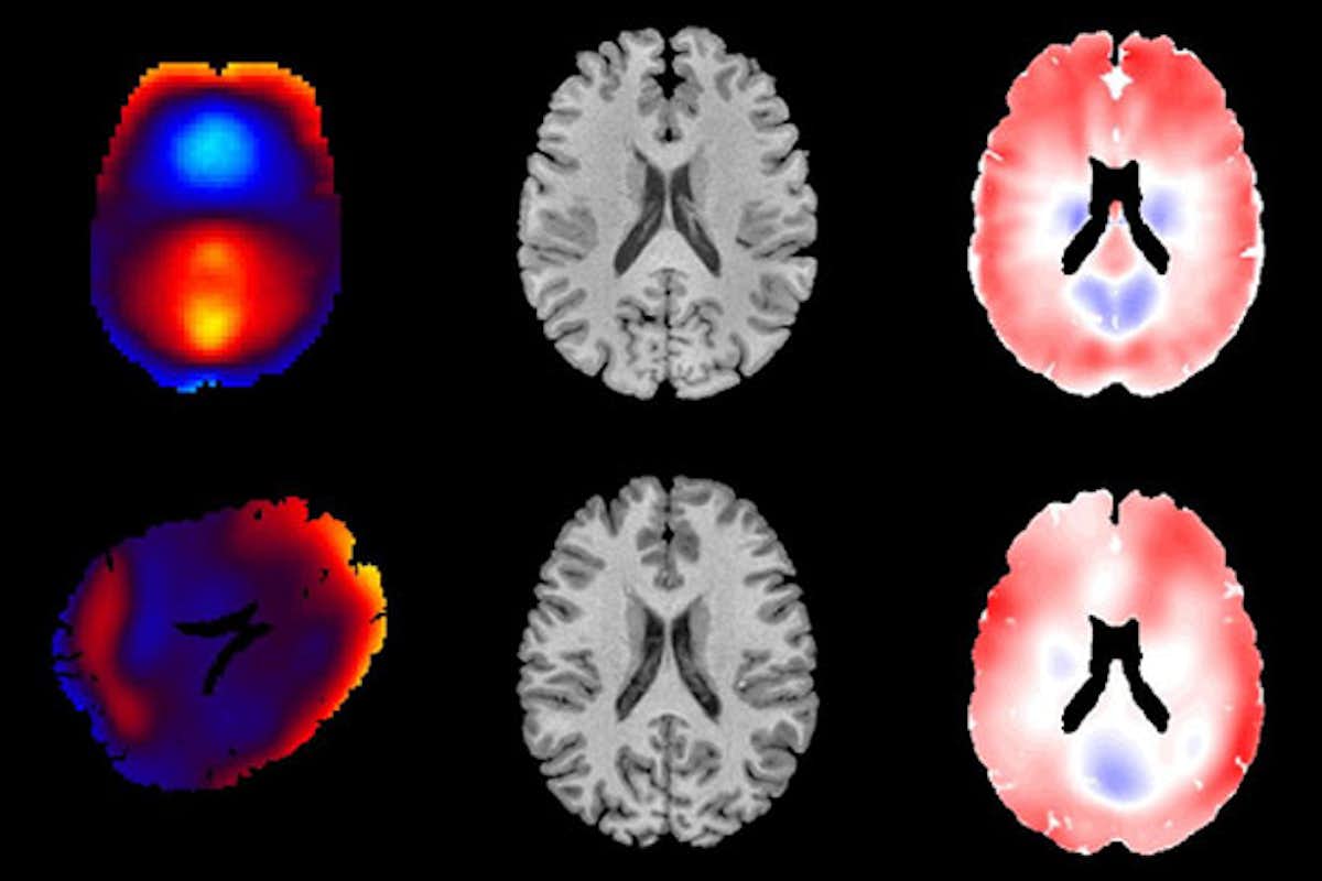Jordan Escarcega in Philip Bayly's lab studied deformation of brain tissue using MRE (top row) and tagged MRI (bottom row). These measurements will be useful to evaluate and improve computer models of brain biomechanics, which can then inform the design of protective equipment and reducing the societal burden of traumatic brain injury. (Credit: Jordan Escarcega) 