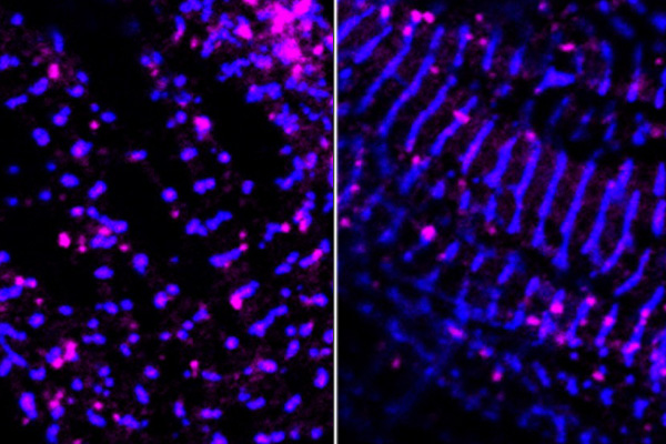  Confocal microscopy reveals the characteristic features of cardiac cells: well-defined striations of the z-discs (α-actinin; blue) and colocalization of Nav1.5 (purple) at the z-disc and intercalated disc nanodomains. This patient-specific tool developed in Jon Silva’s lab allows investigation of unique drug responses that can inform arrhythmia therapy in individuals carrying common variants of the cardiac sodium channel gene. The image on the left is of patient heterozygous hiPSCs, and the image on the right is S1103Y homozygous hiPSCs, the one gene variant that changed in response to the drug mexiletine. (Credit: Silva lab)