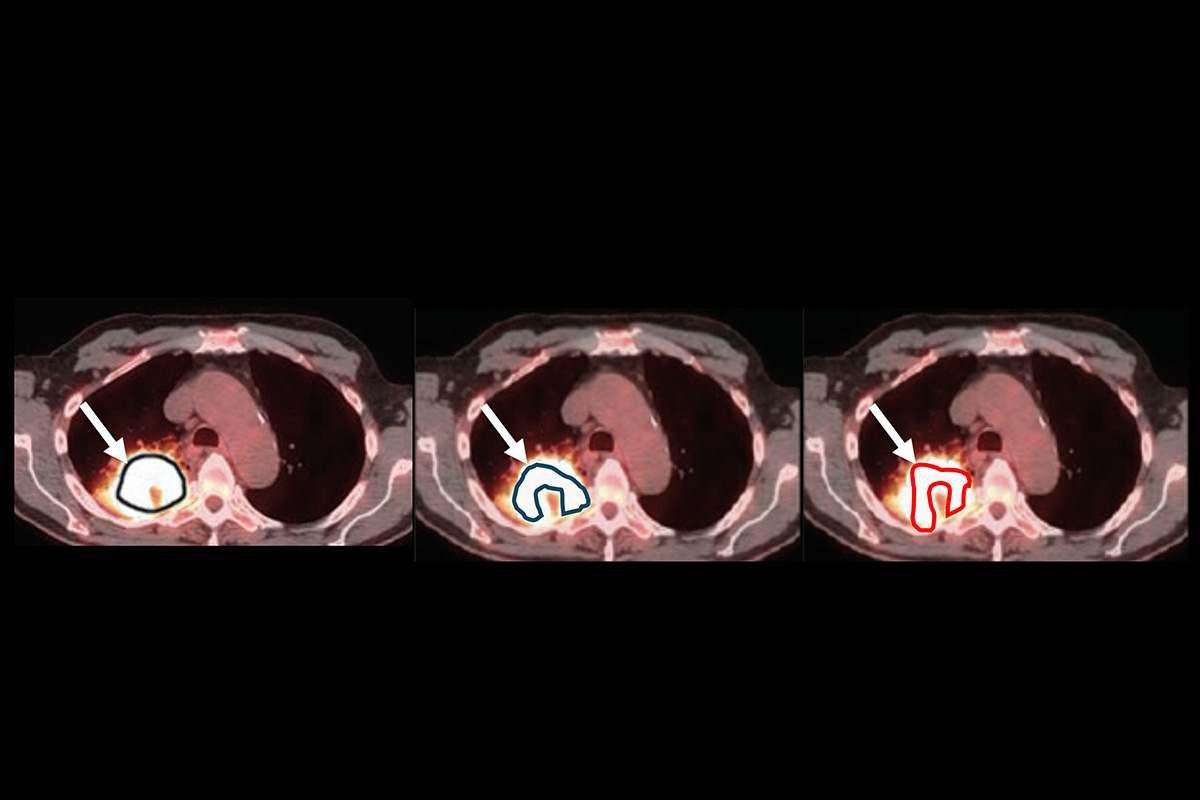 How can quantitative imaging methods be evaluated without knowing the truth? In this example, three tumor-delineation methods yield different tumor-volume estimates from the same clinical image. Without knowing the true tumor volume, it is difficult to determine which method amongst these performs best. The proposed NGSE-Corr technique provides a way to compare such methods without requiring knowledge of the true value. (Image: Jha laboratory / WashU)
