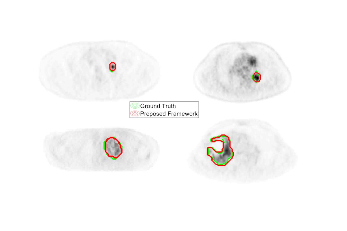 Examples of segmented tumors produced by the proposed framework of patient FDG-PET images where manual segmentations were used as ground-truth.