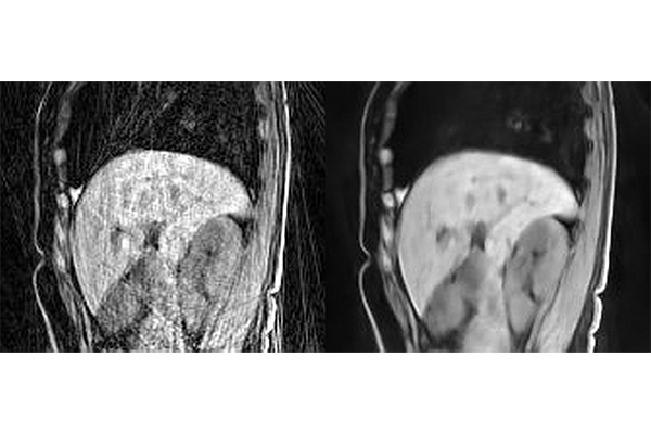 Example images reconstructed using (A) regridding or (B) the Phase2Phase method developed by Hongyu An and Ulugbek Kamilov. The Phase2Phase image was obtained by directly applying the Phase2Phase network trained on CAPTURE images to image in (A).