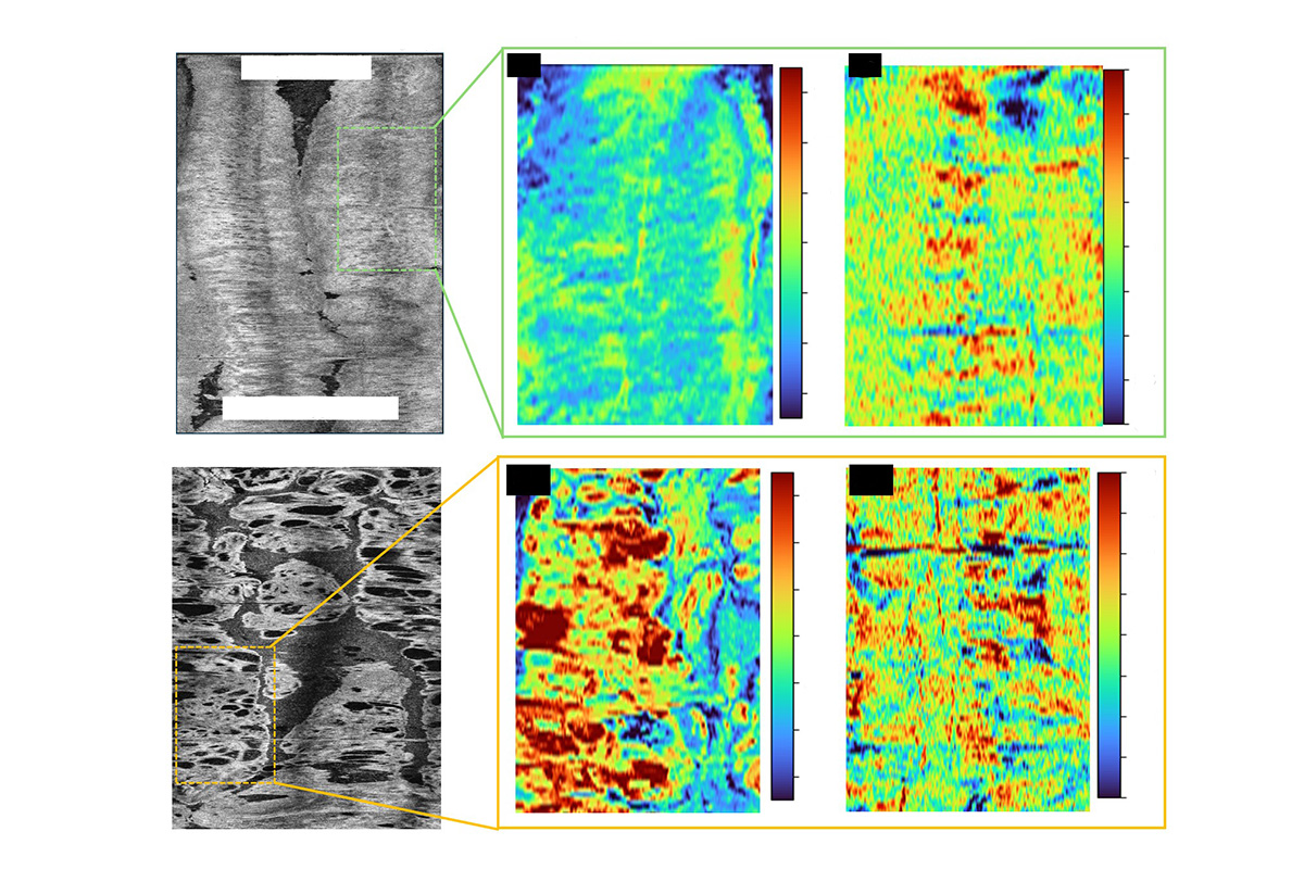  Examples of OCT C-scans from a) Normal endometrium, c) High risk pre-cancer.  OCT intensity C-scan (a1 and c1); optical extinction coefficient (a2 and c2); and scatterer shape factor (a3 and c3) of the highlighted sections. In the high-risk pre-cancer, the 3D OCT image revealed more complex, low-intensity regions, indicative of irregular, dilated glands of various sizes (c1). Compared with a normal endometrium, high-risk pre-cancer showed higher irregularity and heterogeneity. (Credit: Zhu lab)