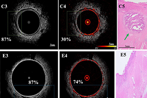 (From left) Ultrasound images, photoacoustic microscopy (PAM)/US images, and  representative hematoxylin–eosin (H&E) stain of the tumor bed.  Panel C: treated tumor bed with residual cancer; Panel E, treated tumor bed with no residual cancer.