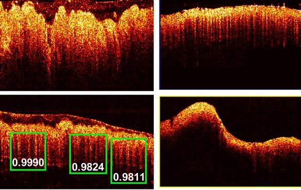 The PR-OCT imaging detected images of colon cancer (top photo) and of normal colon tissue. The green boxes indicate the scores of probability of the predicted "teeth" patterns in the tissue.