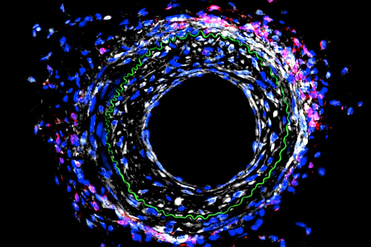 Histological image of mouse blood vessel after mechanical injury. The extent of injury is indicated by cells within the elastin layer shown in green. Cell nuclei are in blue, immune cells in red, and cadherin-11 in white. Note the localization of cadherin-11 with immune cells and its expression in the injured wall. 