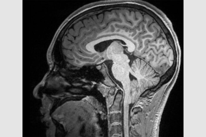 Researchers define new subtypes of common brain disorder | WashU 