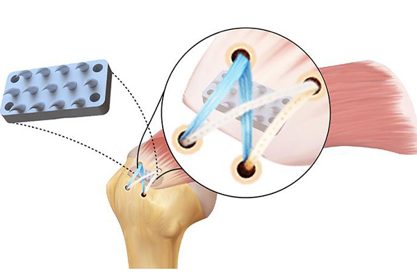 Schematic of the python tooth-inspired device interposed between tendon a bone significantly enhances standard rotator cuff repair. Credit: Iden Kurtaliaj/Columbia Engineering